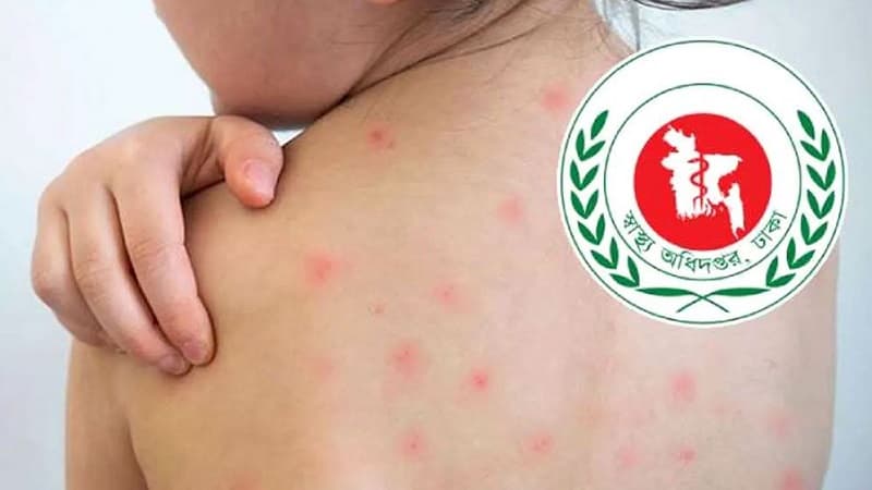 হাম ও উপসর্গে একদিনে আরও ৬ জনের মৃত্যু