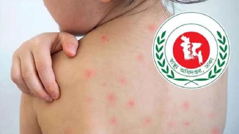 হাম উপসর্গে আরও চারজনের মৃত্যু, আক্রান্ত ১৩৩২