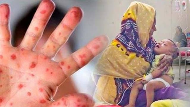 হাম উপসর্গে আরও ৭ প্রাণহানি হাম উপসর্গে আরও ৭ প্রাণহানি
